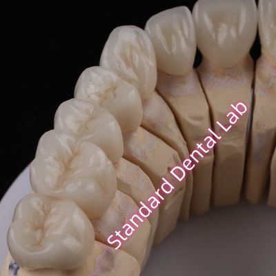 डिजिटल सीएडी सीएएम डेंटल लैब पीएफजेड मुकुट पारदर्शी परतदार जिरकोनिया मुकुट