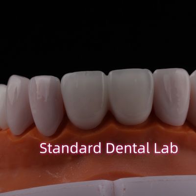 पारदर्शी Emax Zirconia Laminate Veneers चीनी मिट्टी के बरतन दंत veneers रासायनिक रूप से विश्वसनीय