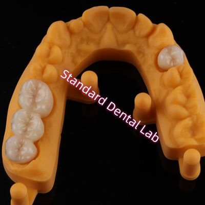 मुकुट सभी चीनी मिट्टी के बरतन सिरेमिक Zirconia Ivoclar सौंदर्य दांत OEM
