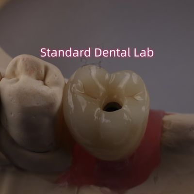 स्क्रू रिटेनड डेंटल इम्प्लांट क्राउन पीएफजेड पोर्सिलेन लेयर्ड जिरकोनिया