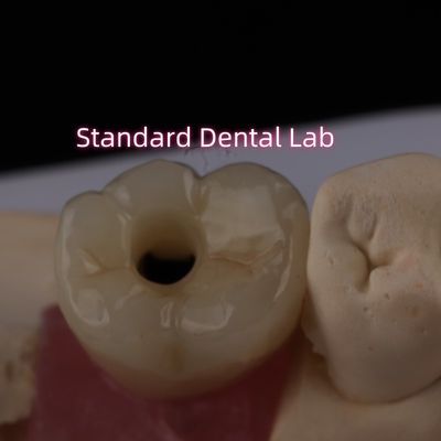पीछे के प्रत्यारोपण क्राउन Bruxier ठोस Zirconia पेंच बरकरार