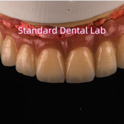 पीएफएम डिजिटल गैर कीमती धातु पोर्सिलेन मुकुट पुल उच्च सौंदर्य प्राकृतिक