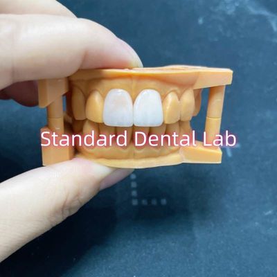 उच्च रंग स्थिरता Ivoclar Emax लमिनेट फ़नीर उच्च पारदर्शिता