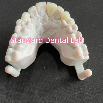 सितारों की मुस्कान दंत दांतों Emax Zirconia Laminate Veneers 0.6 मिमी