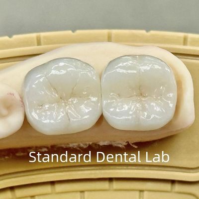 दंत चिकित्सा प्रयोगशाला मुकुट पारदर्शी पूर्ण समोच्च Zirconia उच्च शक्ति के साथ