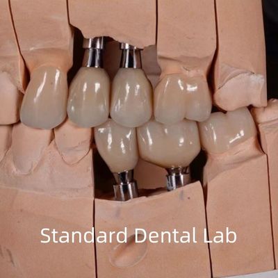 प्राकृतिक दिखने वाले सौंदर्य संबंधी पेंच से बने जिरकोनिया इम्प्लांट मुकुट