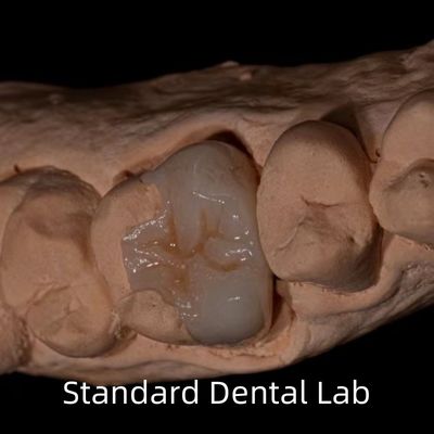 पारदर्शिता Emax Zirconia दंत Inlay प्राकृतिक गुहा के आकार को बहाल करने के लिए Onlay मुकुट