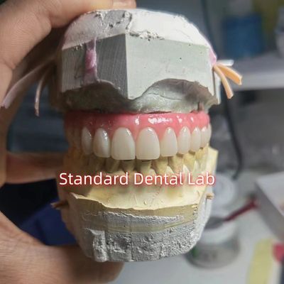 स्क्रू रिटेन टाइटेनियम PMMA डेंटल ब्रिज अस्थायी मुकुट