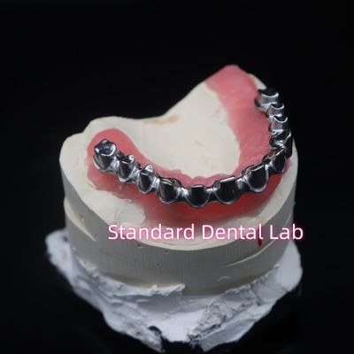 Full Arch Malo Bridge Dental Restoration Zirconia Crowns With Gum Poecelian चीन दंत चिकित्सा प्रयोगशाला