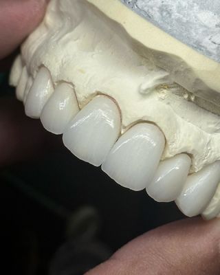 इष्टतम कार्यक्षमता और प्राकृतिक सौंदर्यशास्त्र के लिए पारदर्शिता परत वाला जिरकोनिया मुकुट