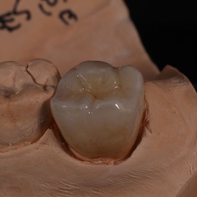 सौंदर्य के अनुकूल परिणामों के लिए पूर्ण समोच्च पारदर्शी जिरकोनिया मुकुट