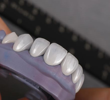 प्राकृतिक दिखने वाले Emax Veneers Crown Biocompatibility न्यूनतम तैयारी के साथ ब्लीचिंग शेड