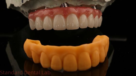 5 वर्ष की गारंटी दंत प्रत्यारोपण मुकुट पीएमएमए ब्रिज ओवर मल्टी यूनिट एबटमेंट्स कस्टमाइज्ड वीटा शेड