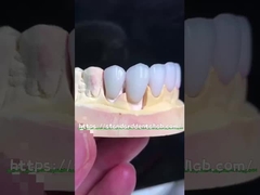 प्राकृतिक दिखने वाले Emax Veneers Crown Biocompatibility न्यूनतम तैयारी के साथ ब्लीचिंग शेड